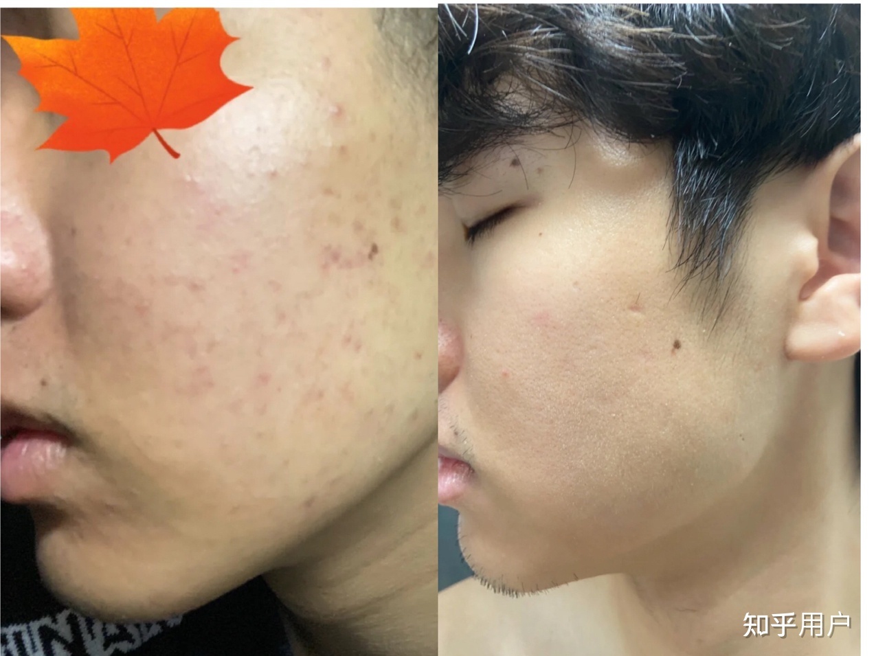 闭口痘痘粗糙