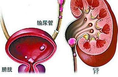 宝宝肾结石有什么症状