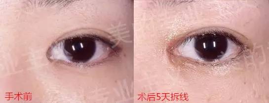 眼角老流泪是怎么回事