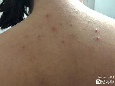 怀孕前期会长痘痘吗