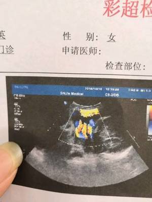胎儿绕颈三周