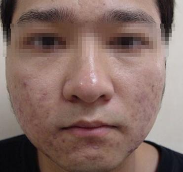 满脸痘痘用什么好