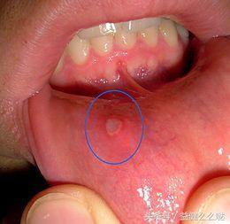口腔溃疡怎样治疗