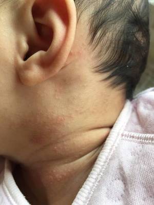 脖子上会起痘痘吗