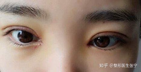 双眼皮上长了个脂肪粒