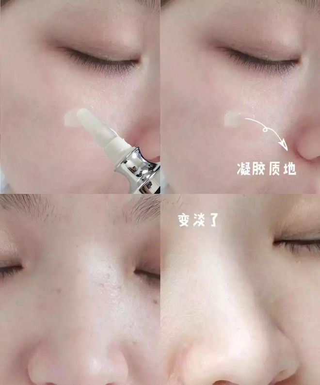 祛斑针需要注意什么