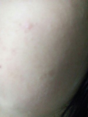 痘痘有多了怎么回事怎么办
