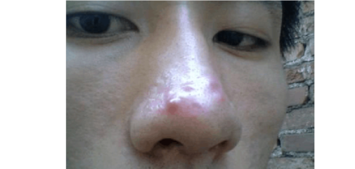 鼻头上长痘痘很红
