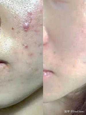 脸上有痘痘多吃啥