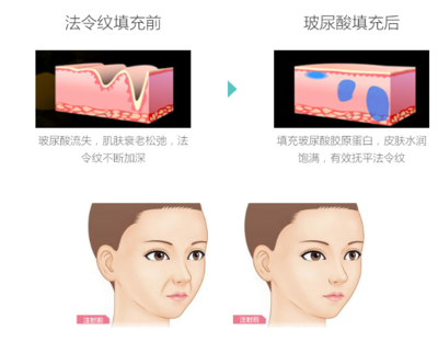 胶原蛋白填充法令纹