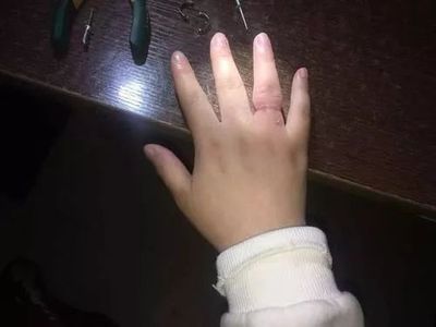 孕晚期手指变粗戒指怎么拿出来
