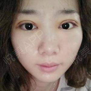双眼皮术后多久可以洗脸