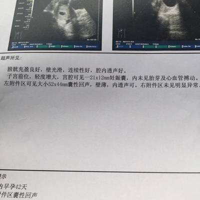 怀孕6周彩超图片