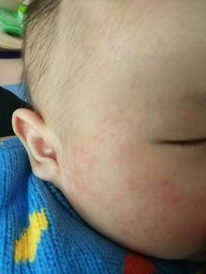 6个月宝宝出疹子症状