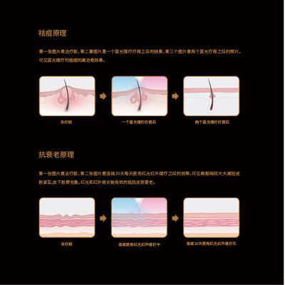 蓝光祛痘原理