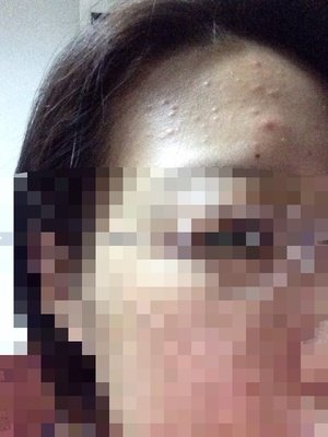 男生多大不长痘痘