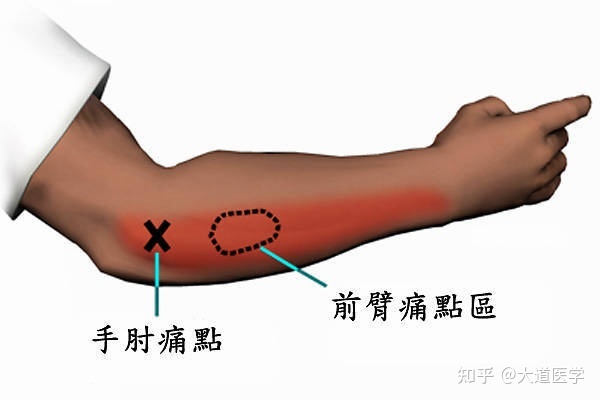 网球肘怎么治疗才能彻底恢复