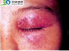 眼睑皮炎怎么治疗