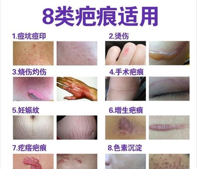 烫伤怎样不留疤痕
