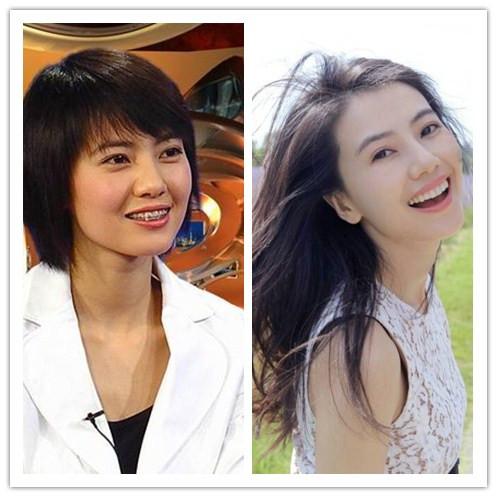 牙套会改变脸型吗