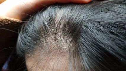 头发出油长痘痘痛怎么办