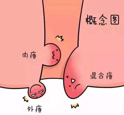 宝宝有痔疮怎么办