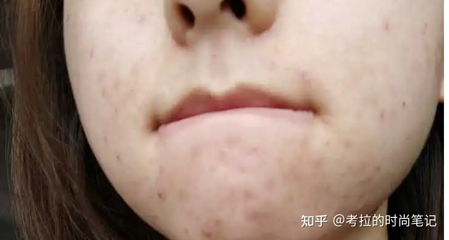 同时爆十几个痘痘