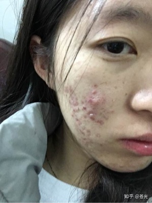 脸颊两侧长小痘痘的原因