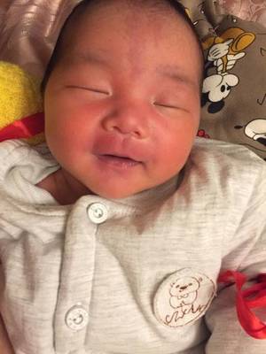 新生儿鲑鱼斑图片大全