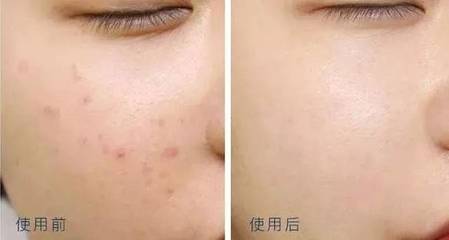 脸上的痘痘几个月都不消
