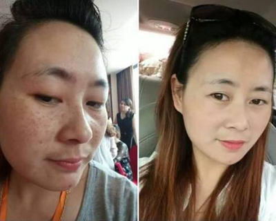 脸上有痘痘适合什么精华
