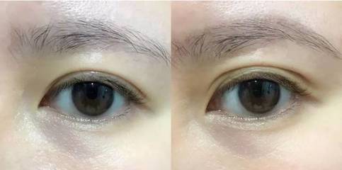 老贴双眼皮贴会怎么样