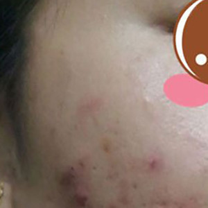 脸上痘痘挂美容科