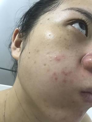 痘痘长完以后皮肤不规整