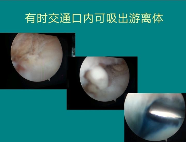 滑膜囊肿怎么治疗