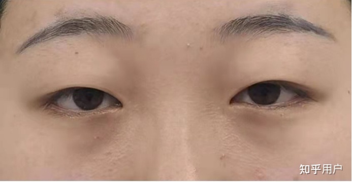 割双眼皮在哪里