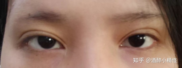 双眼皮上面又条折痕