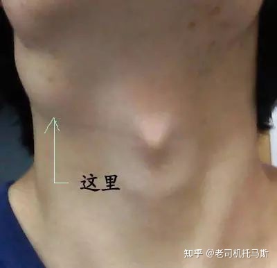 淋巴部位长痘痘怎么治