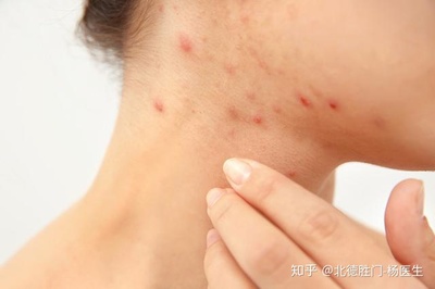 嘴周边长痘痘吃什么