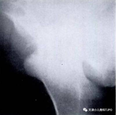 股骨头囊变是怎么回事