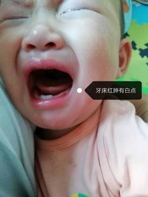 一岁小孩牙龈红肿怎么办