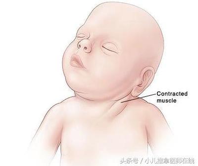 新生儿 斜颈