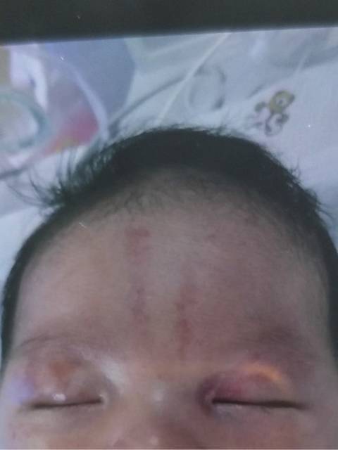 新生儿血管瘤