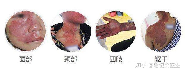 颈部结节怎么治疗