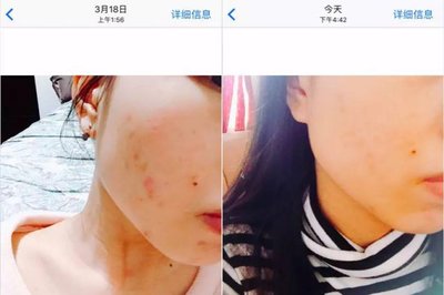 痘痘挤破后怎么不留疤