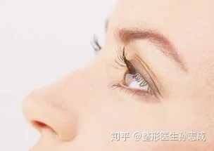 天生三眼皮