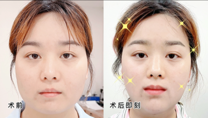 脸部吸脂费用是多少