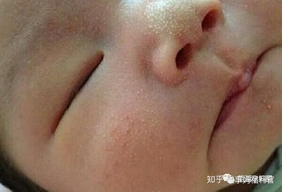 新生儿鼻子有白点怎么回事