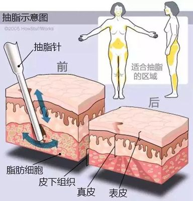 抽脂融脂