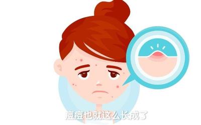 青春期结束后还长痘痘